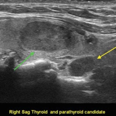 What does a parathyroid ultrasound show?